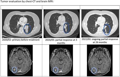 Long-lasting benefit on multimodal treatment combining osimertinib and stereotaxic radiotherapy for metastatic non-small cell lung cancer with the EGFR exon 20 insertion 773-774 HVdelinsLM: a case report